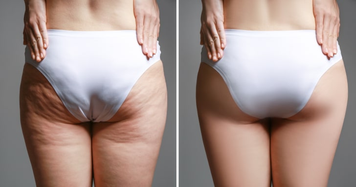QWO 1 Image compare before and after Woman buttocks with stretch marks removal treatment, real people | Bellava Aesthetics in Crestview Hills, KY