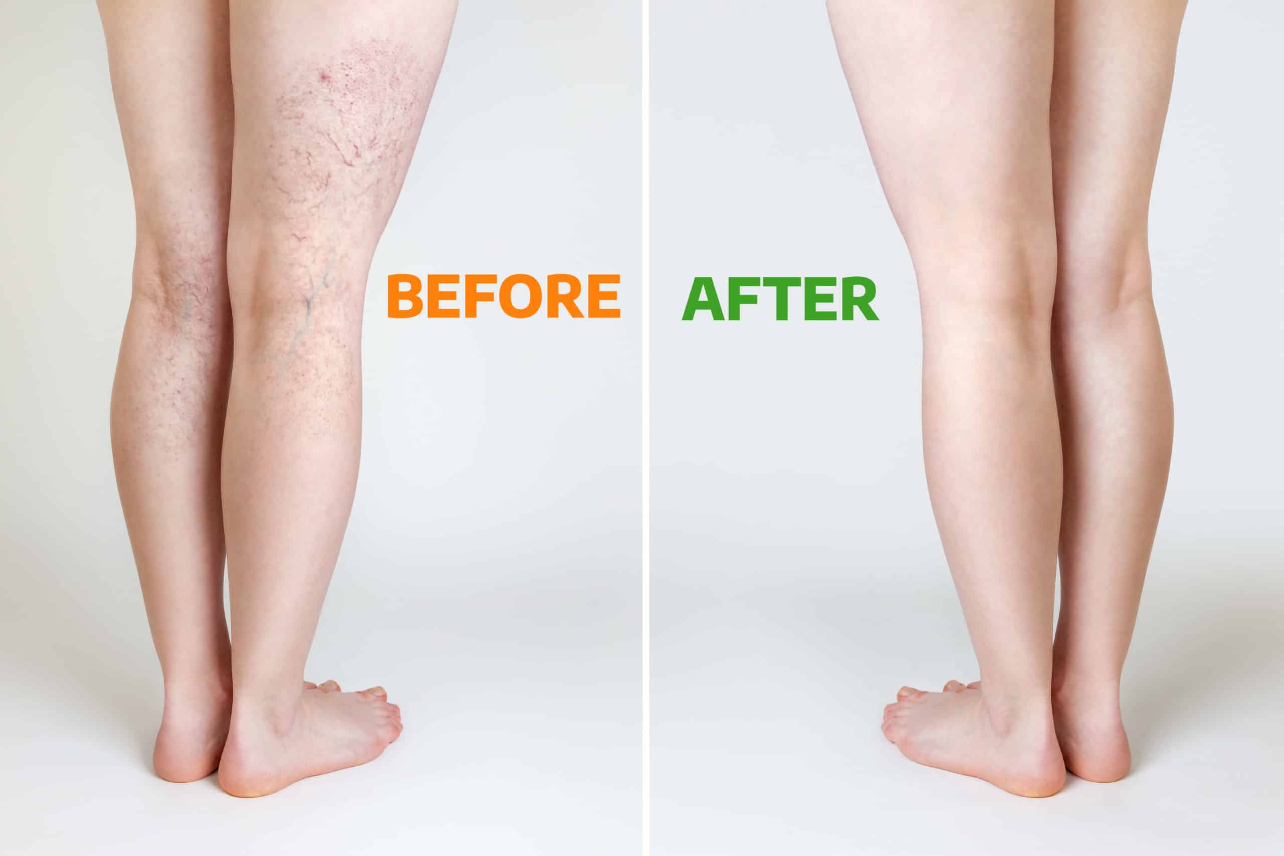 Legs before and after Sclerotherapy | Bellava Aesthetics in Crestview Hills, KY