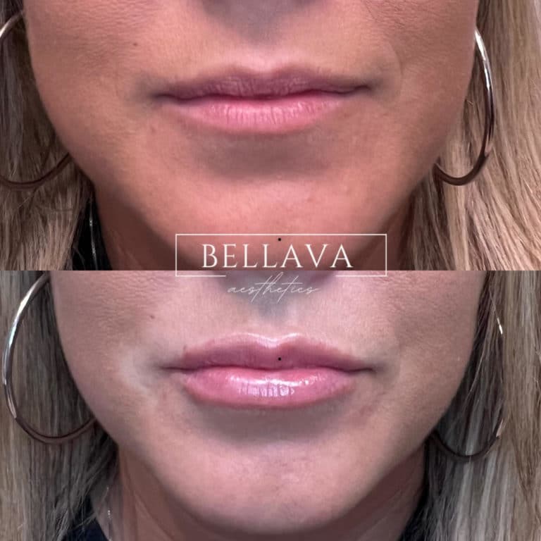 Before and After treatment results of a woman lips | Bellava Aesthetics in Crestview Hills, KY