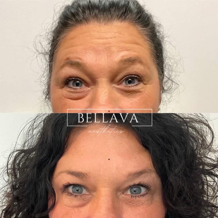 Face of a woman before and after a botox treatment to smooth expression lines. Concept of anti-aging and rejuvenation cosmetics on forehead wrinkles | Bellava Aesthetics in Crestview Hills, KY