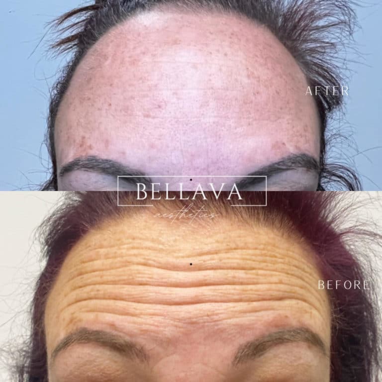 Before and After treatment results of a woman forehead | Bellava Aesthetics in Crestview Hills, KY