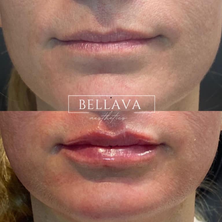 Before and After treatment results of a woman lips | Bellava Aesthetics in Crestview Hills, KY