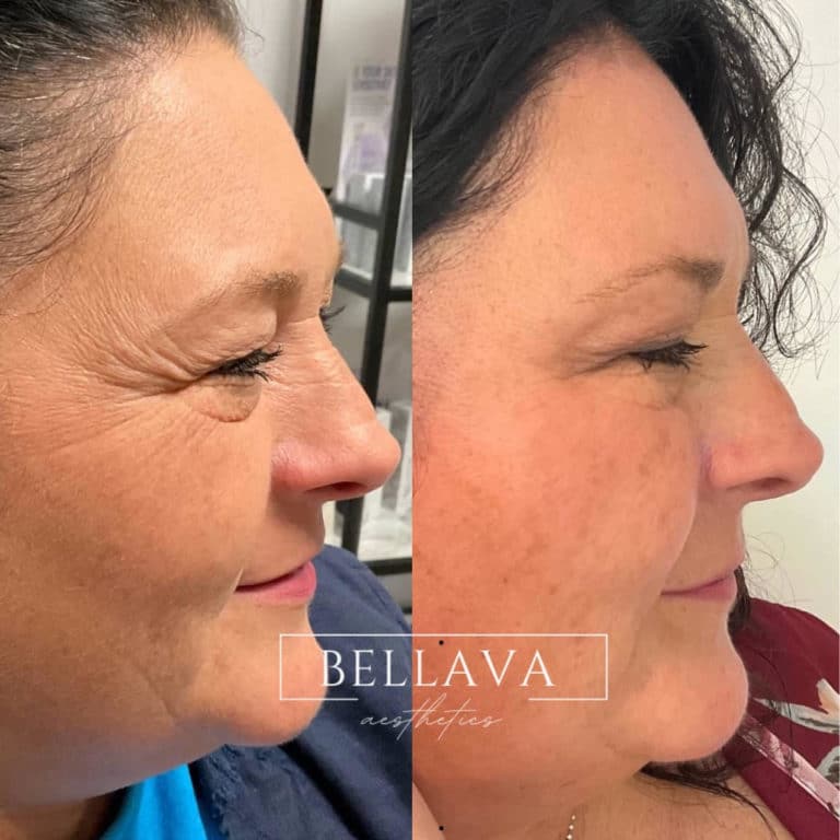 Before and After treatment results of a woman cheeks | Bellava Aesthetics in Crestview Hills, KY