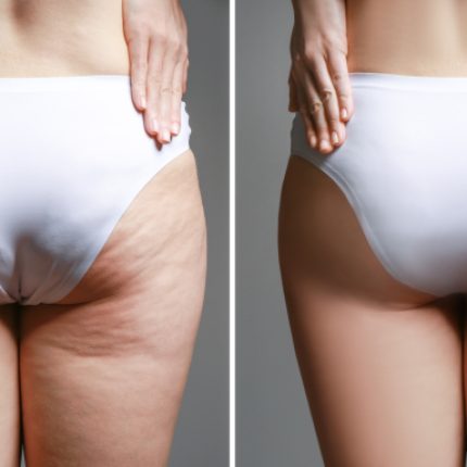 Image compare before and after Woman buttocks with stretch marks removal treatment, real people | Bellava Aesthetics in Crestview Hills, KY